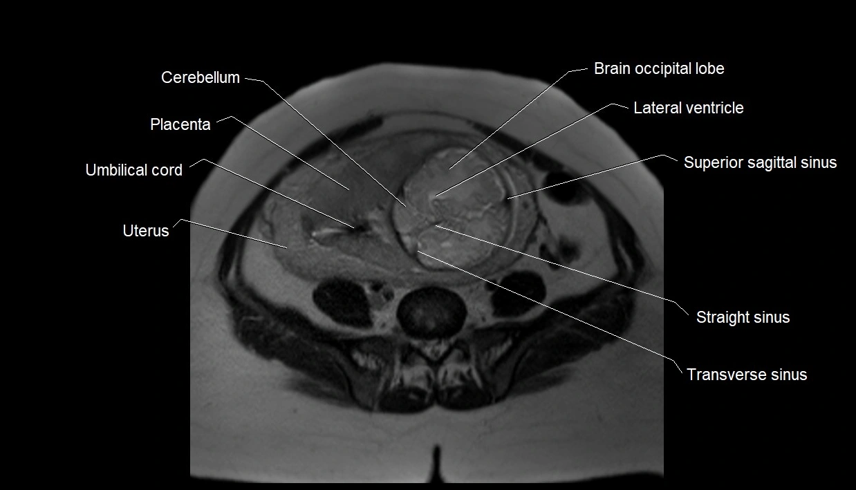 MRI fetal anatomy axial image 25.webp